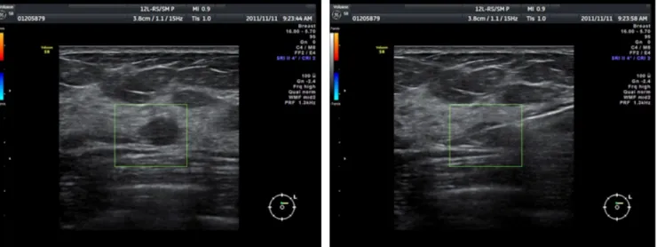 Fig. 1. Core needle biopy procedure, this sonogram of breast shows the core needle penestrating the central portion of the breast mass avoiding ves- ves-sels via color Dㅇppler.