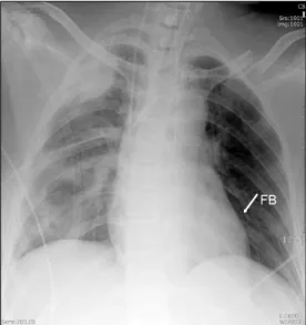 Fig. 3. The about 15 cm sized rubbery material retrieved from  the left pulmonary artery.