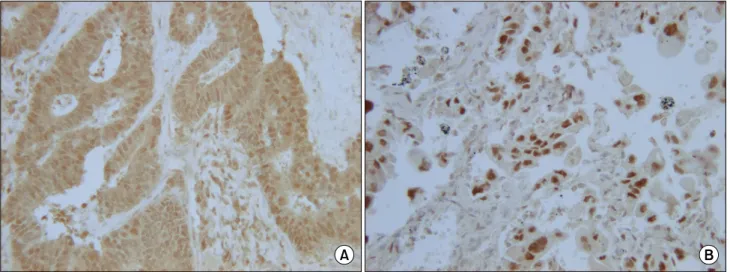 Fig. 1. Immunohistochemical staining of caspase-3 (A) and c-myc (B) in patients of non-small cell lung cancer