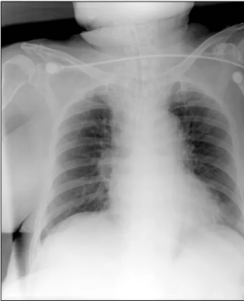 Fig. 4. Chest roentgenogram shows upper mediastinal widening.고      찰    급성  종격동염은  종격동  결체조직의  중증  염증질환으로  높은  사망률과  합병증을  동반한다