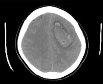 Fig. 4. (A) Macroscopic finding of metastatic lesion in the brain and (B) Microscopic examination of the removed tumoral bleeding from the brain (H&amp;E, 