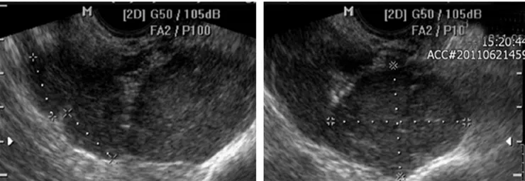 Fig. 3. Right ovarian tumor: operating finding.