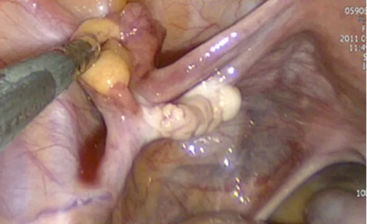 Fig. 5. Right ovarian dysgerminoma pathologic finding (H&amp;E, ×400).