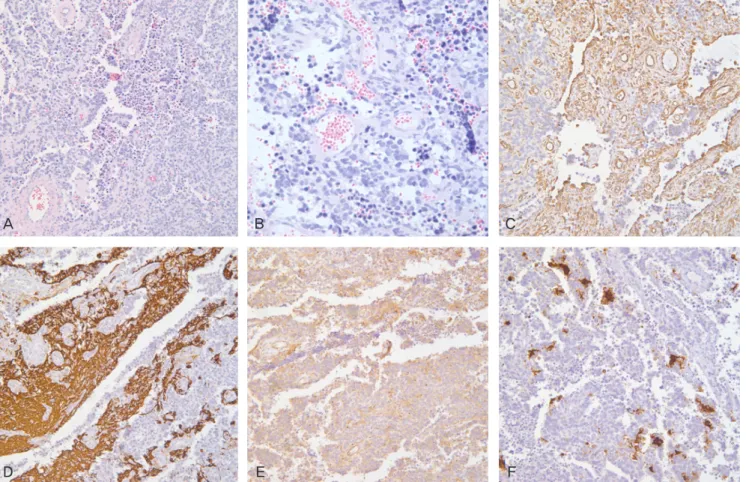 Fig. 1. Primitive neuroectodermal tumor of the ovary. The tumor is composed of nondescript small blue cells arranged in a patternless manner