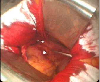 Fig. 2. This figure shows left minithoracotomy at third intercostal  space and Chitwood aortic cross clamp is inserted at second  in-tercostal space