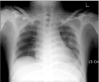 Fig. 2. Preoperative chest CT shows pericardial effusion.