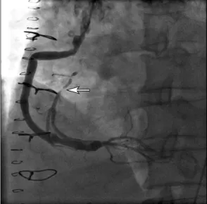 Fig. 2. Coronary angiography shows good graft patency and prox- prox-imal stenosis of right coronary artery (arrow).