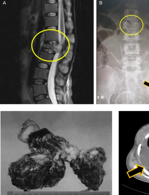Fig. 2. Intraoperative finding. A friable right ovarian mass measuring 7 