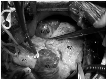 Fig. 3. Left atrial appendage aneurysm viewed from a median  sternotomy. LAAA=Left atrial appendage aneurysm; Ao=Aorta; RV= 