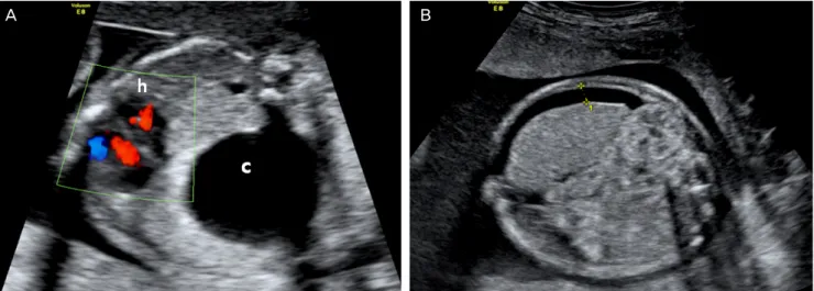 Fig. 2. Postnatal chest computed tomography. The hypoinflated right lung (h) with inner large cyst (c) and mediastinal shift were seen
