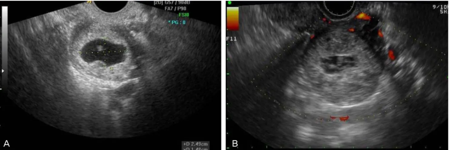 Fig. 2. Transvaginal sonogram shows tubal pregnancy containing embryo before methotrexate injection (A) and collapased G-sac after the procedure (B)