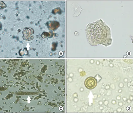 Fig. 1. Images of urine sediments  (with arrow) for the external quality  assessment. (A) CUI-16-01 sulfadiazine  crystal (original magnification ×400)