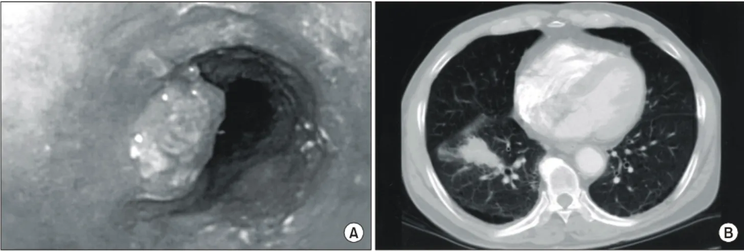 Fig. 2. A: Microscopic finding of the esophageal mass shows infiltrating tumor consisted of moderately differentiated neoplastic  squamous cells (H&amp;E stain, ×40), B: Microscopic finding of the lung mass shows ill defined tumor tissue consisted of moder