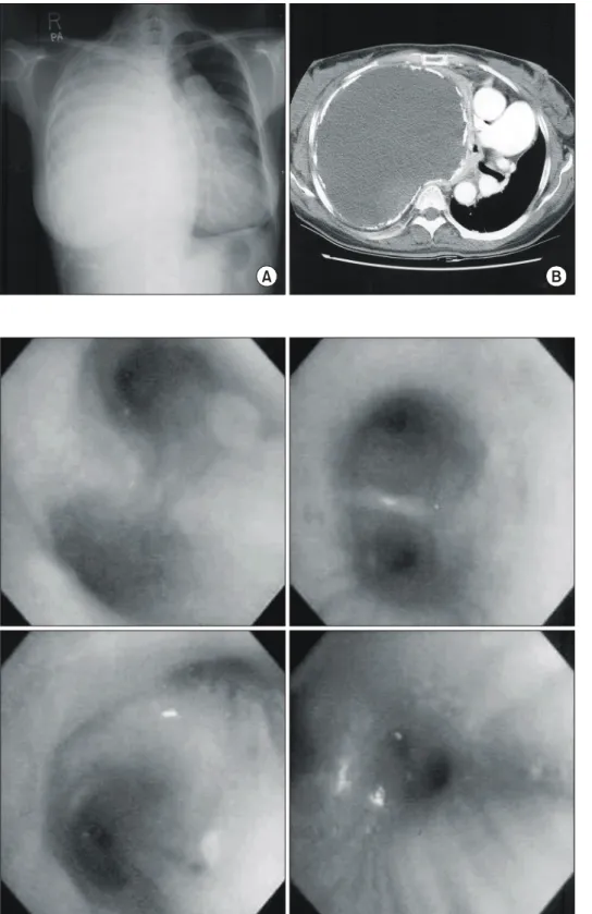 Fig. 1. Initial chest film and com- com-puted tomography. The right  hemi-thorax is totally opacified and large calcified mass is seen