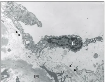 Fig. 2. Transmission electron micrograph shows partial detach- detach-ment of endothelium without nucleolysis and exposure of  base-ment membrane (arrows) under the mechanical stress of gas  insuf-flation  (×5000) (E=Endothelial cell; IEL=Internal elastic 