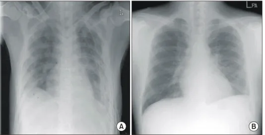Fig. 3. Post operative chest x-  ray. A: Immediate chest x-ray. 