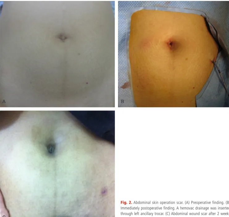 Fig. 2. Abdominal skin operation scar. (A) Preoperative finding. (B)  Immediately postoperative finding