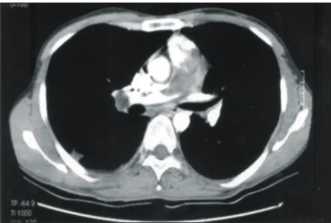 Fig. 2. Gross finding shows 6×6×3 cm sized milky white  myxoid mass.