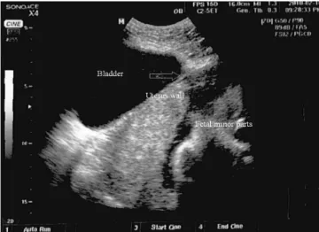 Fig. 3. Rupture site in upper posterior wall of the uterus during the 2nd  uterine rupture.