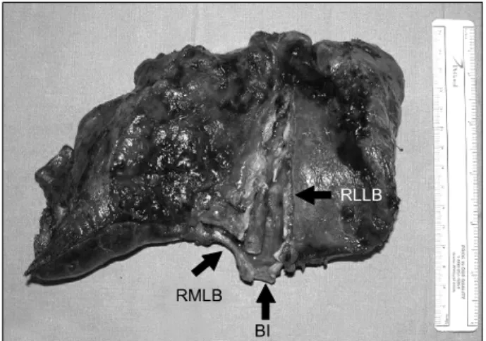 Fig. 3. A foreign body in the resected lung, which is obstructing  the bronchus intermedius (BI) as well as the right middle (RMLB),  and the lower lobe bronchial orifices (RLLB).