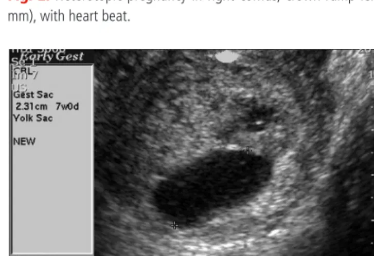 Fig. 3. Right cornual gestational sac, 1 day after selective fetal reduction.