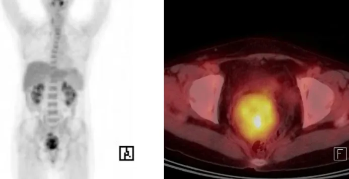Fig. 3. Positron emission tomography/computed tomography showed several recurrent masses with abnormal fluorodeoxyglucose uptake in the pelvic  cavity