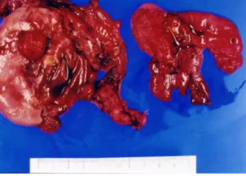 Fig. 3. Serous carcinoma of the ovary illustrates poor differentiation (H&amp;E, 