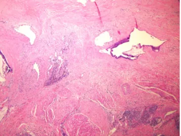 Fig. 4. Mucin-secreting columnar cell invades urinary bladder muscle  layer (H&amp;E, ×40).