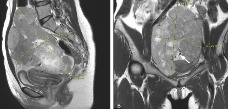 Fig. 1. Magnetic resonance imaging (MRI). The coronal and sagittal T2-weighted MR images (A, B) show large multilobulated mass with heterogeneous  high signal intensity and multifocal necrotic foci