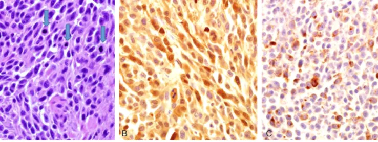 Fig. 3. (A) The malignant melanoma is composed of elongated tumor cells with prominent nucleoli (H&amp;E, ×400)