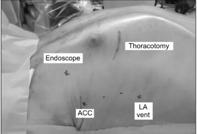Fig. 1. Operative set up. ACC=Aortic cross clamp; LA=Left  atrium.서      론    정중흉골절개술은  일반적인  심장수술  시  넓고  확실한 수술 시야를 확보할 수 있는 장점이 있어 표준적인 심장접근법으로 사용되어왔다[1]
