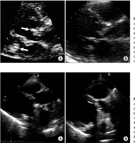 Fig. 1. (A) Preoperative 2-D echo- echo-cardiogram shows mobile  vegeta-tion attatched to mitral valve &amp; 