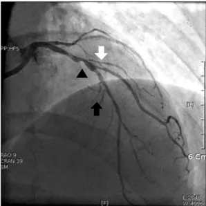 Fig. 2. Final angiogram shows the well-expanded stent in the left  anterior descending artery, with IVUS catheter tip lodged within  the stent (arrow).