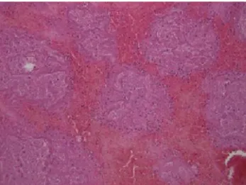 Fig. 3. Pulmonary arterial thromboembolism: microscopic finding reveals  red blood cells, scattered inflammatory cells and fibrin clot showing lines  of Zahn (H&amp;E, ×200)