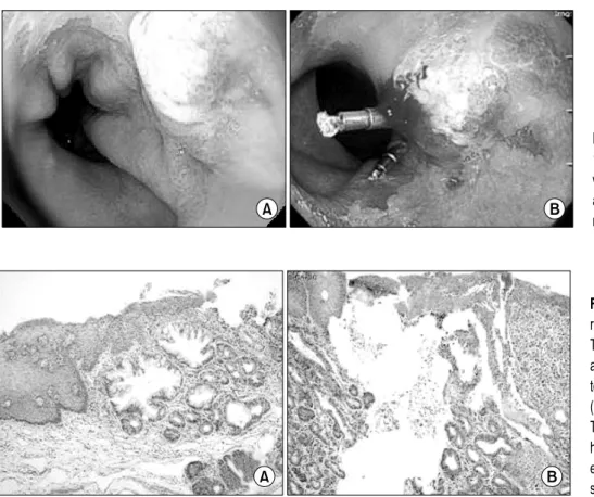 Fig. 1. Endoscopic findings. (A) A  1.5×1.5 cm sized elevated mass  was located above the  esoph-agogastric junction