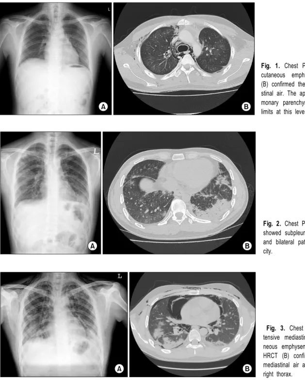 Fig. 1. Chest PA (A) showed sub- sub-cutaneous emphysema, and HRCT  (B) confirmed the presence of  media-stinal air