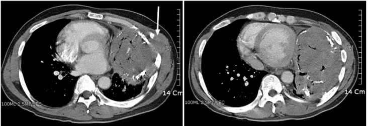 Fig. 4. Postoperative chest X-ray.