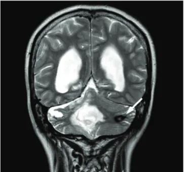 Fig. 2. (A) Fat suppressed T2 weighted sagittal MR image of spin shows a small nodular mass (white arrow) with high signal on dorsal portion of spi- spi-nal cord at C7 level
