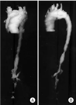 Fig. 3. Angiography shows severe stenosis of T11-12, L2-3 level aorta with long  segmental  narrowing.