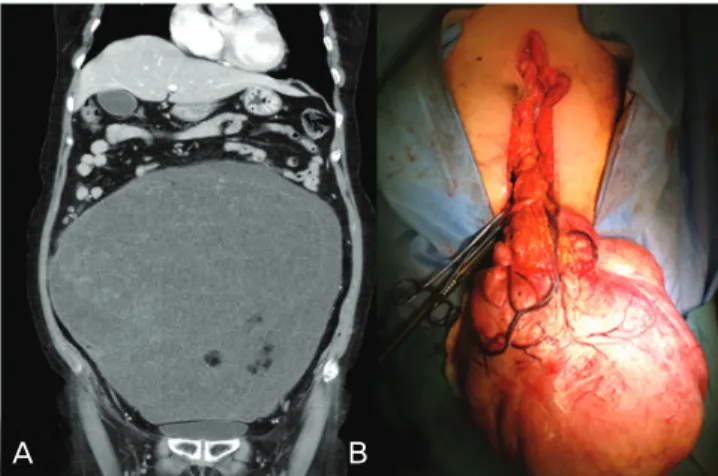 Fig. 2. (A) The tumor cells are slender or slightly plump cells with cytoplasmic longitudinal striation and moderate nuclear atypism (H&amp;E, ×100, enlarged 