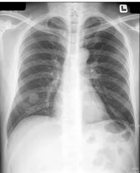 Fig. 1. Chest X-ray: Around mass-lide density in the right lower  lung  field.