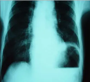 Fig. 1. Preoperative chest PA.; elevated left side diaphragm &amp;