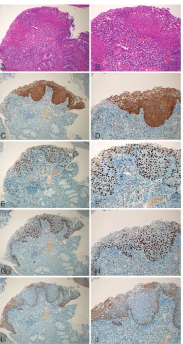 Fig. 2. The association of positive P16, Ki-67, p63, and CK17 immunohis- immunohis-tochemical expressions with high risk HPV infection