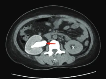 Fig. 3. Contrast-enhanced coronal CT image shows lymph node enlargement in aortocaval and left paraaortic area (arrow)