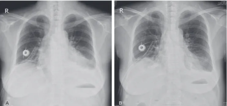 Fig. 1. Pericardial effusion before pericardiocentesis (A) and after pericardiocentesis (B).