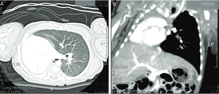 Fig. 3. Axial CT scan of the infant’s head imaged with no visualization of right lung parenchyma and airway