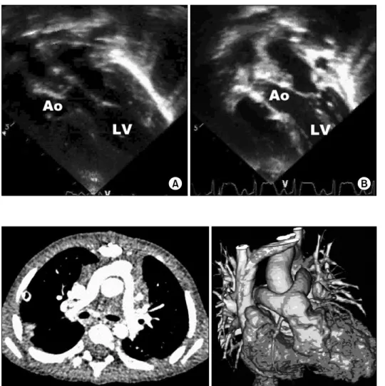 Fig. 2. Postoperative 3D CT an- an-giography showed that aortic  translocation with biventricular  out-flow tract reconstruction results in  a more “normal” anatomic repair  when compared with the Rastelli.