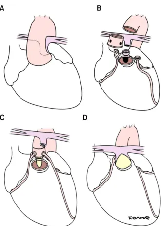 Fig. 3. Surgical methods. (A) The aorta arises from RV, and se- se-vere stenotic PA arises from LV