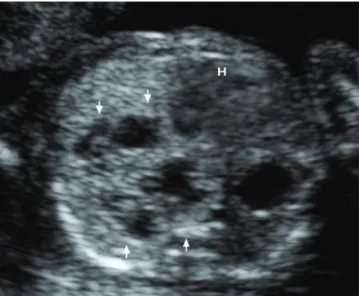 Fig. 2. Transverse sonogram of the fetal chest shows an echogenic lung  mass of bronchopulmonary sequestration (white dotted line).