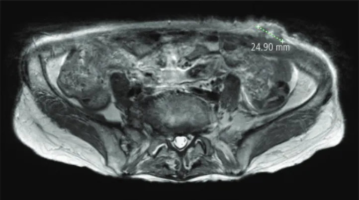 Fig. 1. The MRI fi nding of extrafascial metastatic mass (green line mea- mea-sured) after laparoscopic operation.